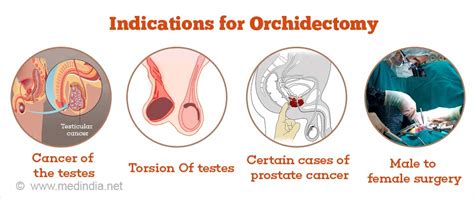 Urologists perform orchiectomies by making a small incision in either the groin area or the scrotum and removing the testicle. . Bilateral orchiectomy side effects